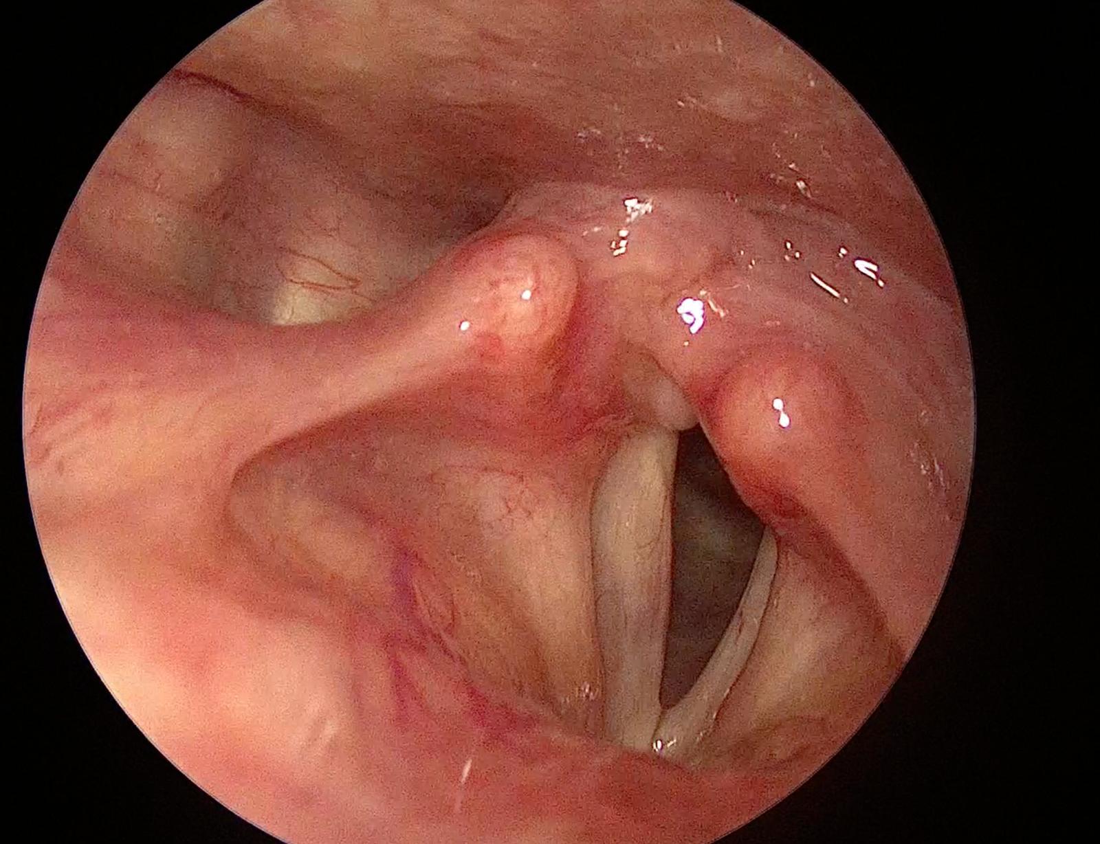 Ses Teli Felci Tedavisi