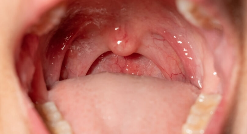 Bademcik Küçültme