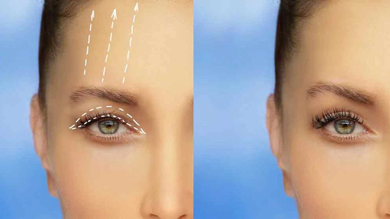 Göz kapağı estetiği