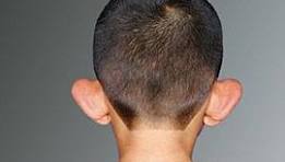 Kepçe Kulak Estetiği (Otoplasti)