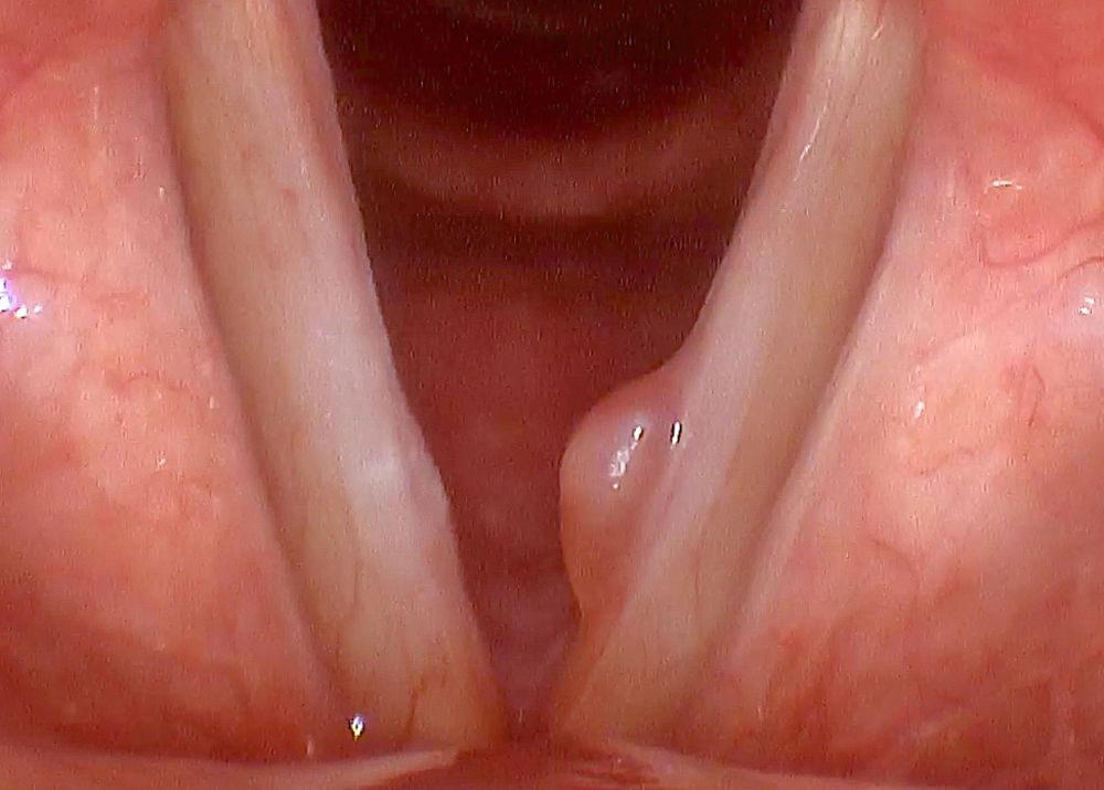 Ses Teli Polibi Tedavisi